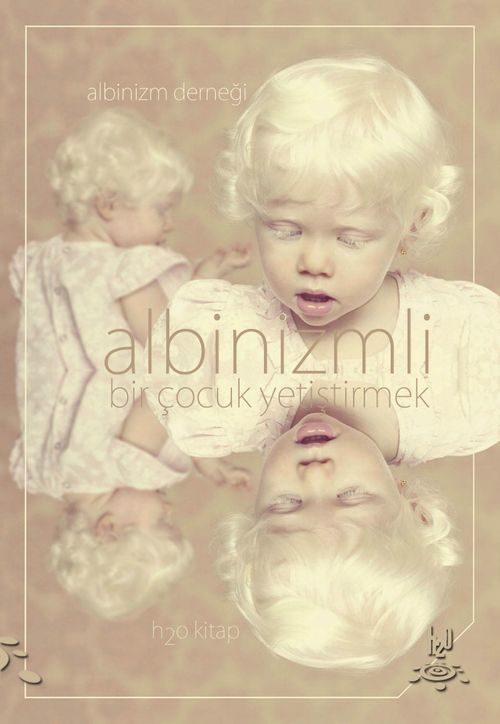 Albinizmli Bir Çocuk Yetiştirmek