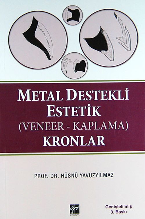 Metal Destekli Estetik (Veneer-Kaplama) Kronlar